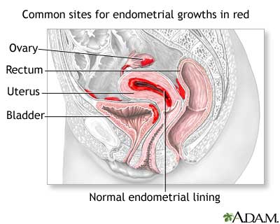 Endometriosis treatment