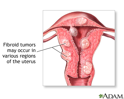 Uterine fibroids evaluation and treatment